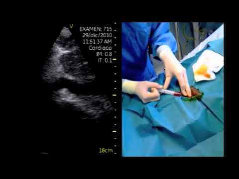 Pocket-Sized Ultrasound Leaded Incision Of The Pericardium