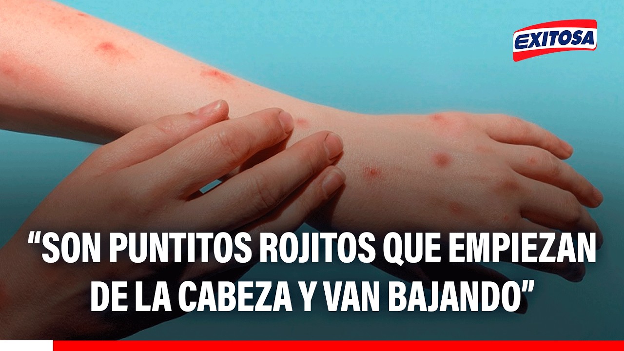🔴🔵 Óscar Malpartida Tabuchi: "Son puntitos rojitos que empiezan de la cabeza y van bajando"