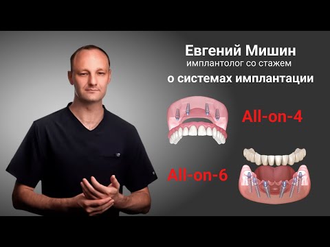 Центр Имплантации Зубов: интервью имплантолога о системах имплантации зубов «все на 4» и «все на 6»