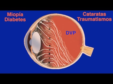 Vitreous Detachment: Floaters, Flies, and Lights - Bonafonte Ophthalmology Center