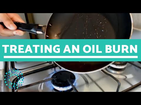 Treating an OIL BURN - What To Do!