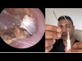 1,510 - Extremely Itchy Dead Skin Accumulation Removed from Ear | Learn About Zoellner Suction Probe