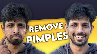 Get Rid of Pimples Forever In 2 STEPS (100% Guaranteed Results)
