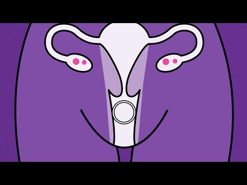 Brook Contraception - Vaginal Ring Animation