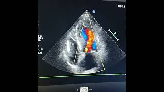 Download lagu #cardiology #biology #MR #2decho #mitralvalve mp3 Download lagu #cardiology #biology #MR #2decho #mitralvalve mp3