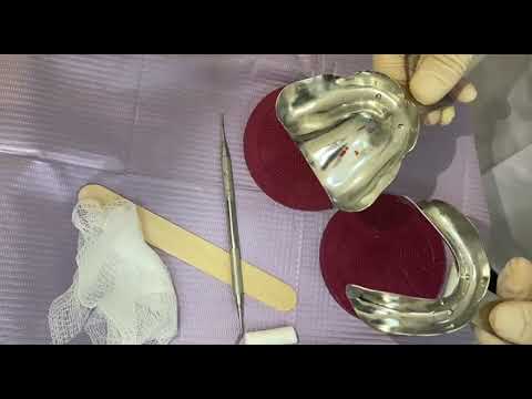 Visit 1 Management of a high palatal vault