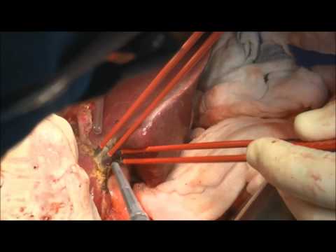nonStick flush and maXium® EHT hepatectomy
