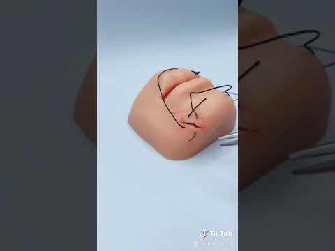 Suture Technique: Figure 8
