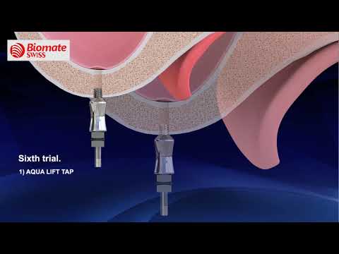 Sinus Crestal Approach Kit