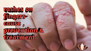 rashes on fingers | itching between fingers |causes of black spots ,cuts & itching on fingers