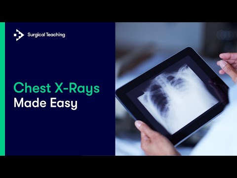Chest X-Rays Made Easy