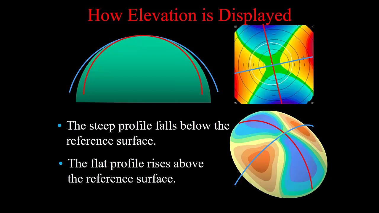 [Online Seminar] Michael W Belin: Everything You Need to Know about Keratoconus from A to D