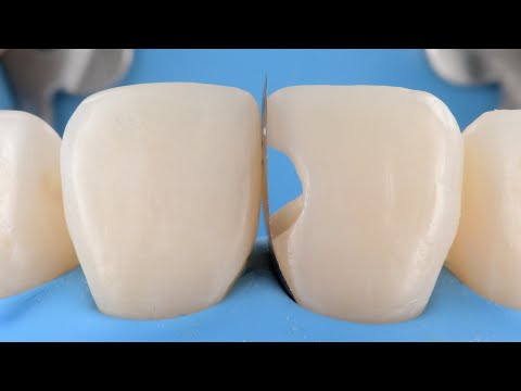 Matryca w odbudowie zębów przednich