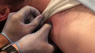 Dry Needling - What is it?