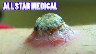 Black Heads, Beauty, Blemishes & Surgery - All Star Medical Trailer!