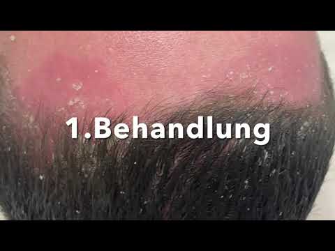 NEW Swiss Acne, Psoriasis, Eczema, Damaged skin Treatment