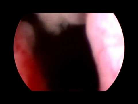 guz w cewce sterczowej - cystoskopia