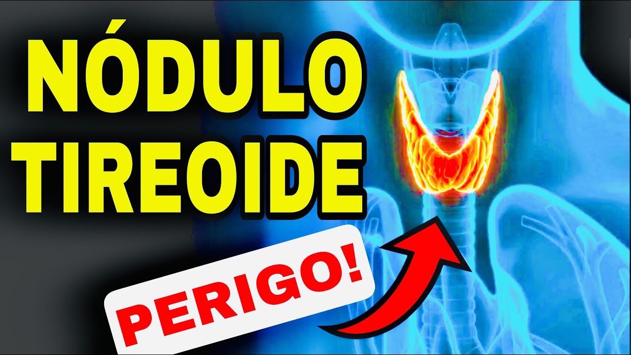 7 SINAIS mais PERIGOSOS de um NÓDULO na TIREOIDE e 4 Fatores de RISCO para CÂNCER na TIREOIDE