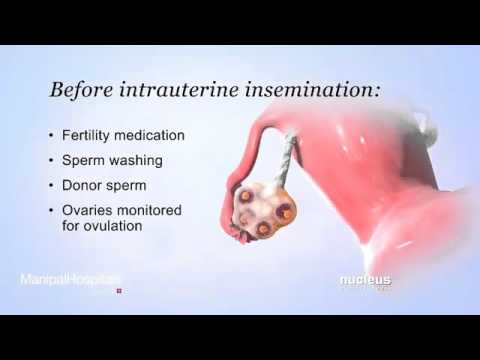 Iui- intrauterine insemination