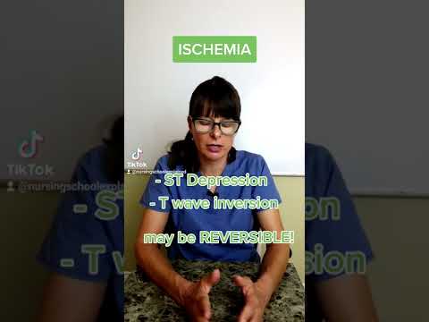 Chest pain - Ischemia, injury, infarction & EKG changes #shorts