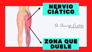 ¿Cuál es la diferencia entre dolor del nervio ciático y ciática