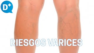 ¿Existen riesgos al tratar las varices