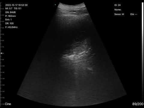 BEDSIDE ULTRASOUND WITH CERBERO ATL Wireless Probe - Acute Pneumonia with pleural effusion