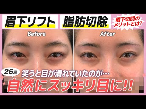 笑うと潰れる目を改善！笑顔をより素敵に！【眉下リフト＋脂肪切除】