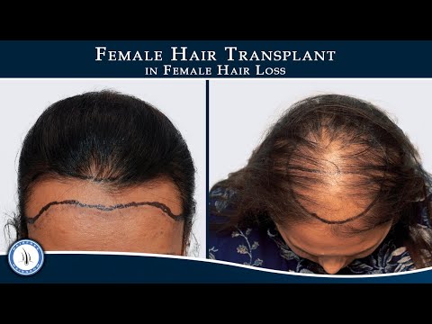 Female Hair Transplant || Female Hair loss || Female Hairline Designing || HFHG Clinic Surat