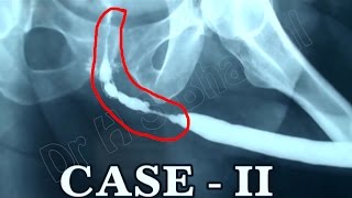 Buccal Mucosal Urethroplasty for Long Stricture Urethra by Dr H S Bhayal B L Kapoor Hospital