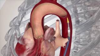 Good Day PA - Part 1 - Penn State Heart and Vascular Institute.