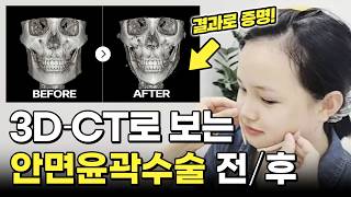 뼈를 포 뜨듯 얇게 절제한다고요? 신경선도 살리고 예쁨도 올리고! 3D-CT로 전후 직접 보여드립니다