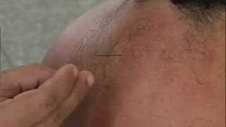 Acupuntura 4