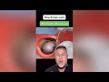 How Things Work Wisdom Teeth Removal