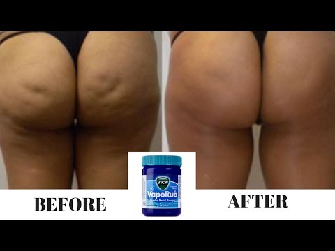 Talagang mangayayat sa pamamagitan ng 10 kg para sa isang linggo sa bahay Repolyo sabaw slimming