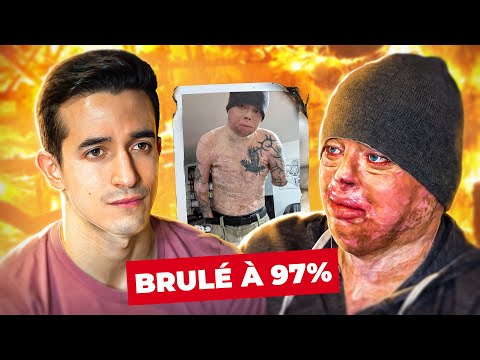 Brûlé à 97% : il racconte son terrible accident (le plus grand brûlé au monde)
