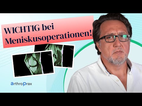 Misdiagnosis of a meniscus tear