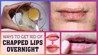 Cure dry / chapped lips overnight | 100% results overnight