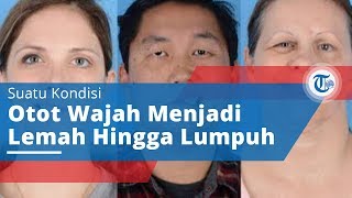Penyakit Bell's Palsy - Suatu Kondisi Otot Wajah Melemah hingga Lumpuh