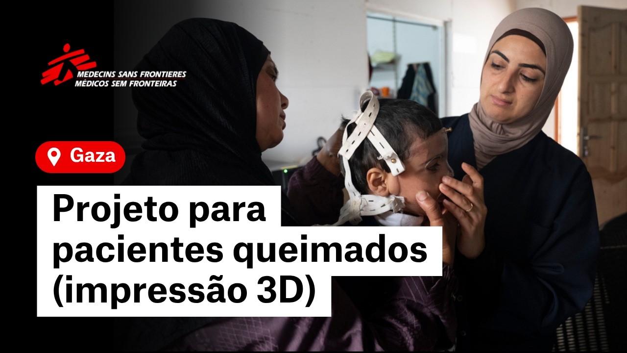 Gaza | Próteses 3D para tratar queimaduras graves