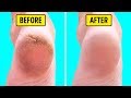10 Natural Home Remedies For Silky Smooth Feet