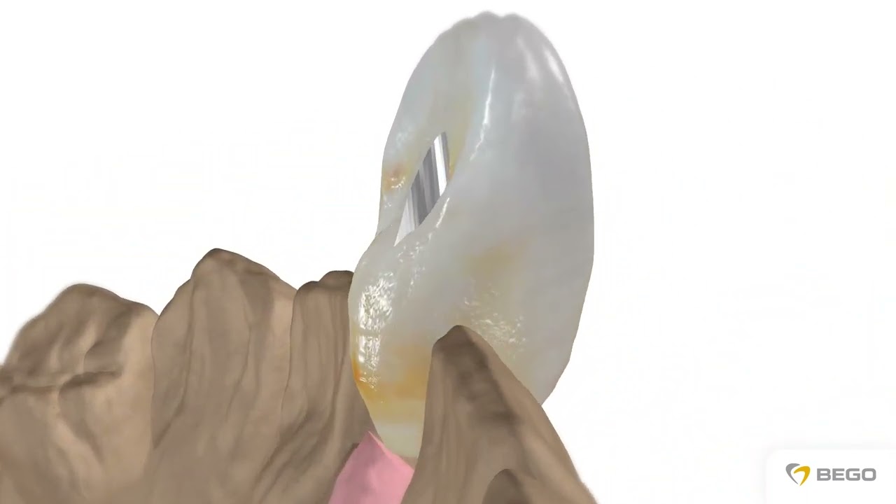 Implantoprotetyka – praca przykręcana – korona z antyrotacją