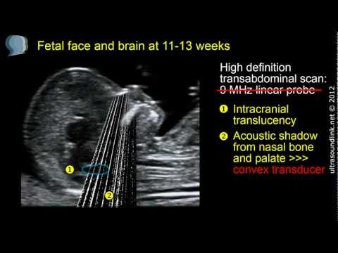 Fetal face and brain: high definition scan at 11-13 weeks