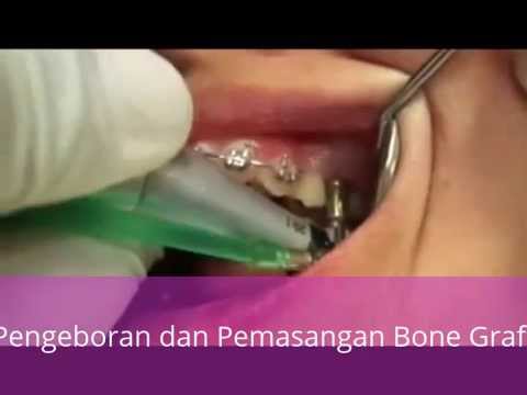 Prosedur Implan Gigi atau Dental Implant