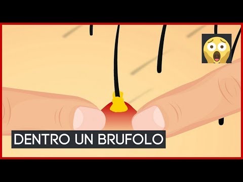 Sudorazioni notturne osteocondrosi Intervento chirurgico per rimuovere le cisti nel prezzo ginocchio