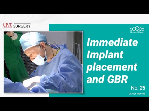Sofortige Implantatplatzierung nach Extraktion und GBR (Guided Bone Regeneration)