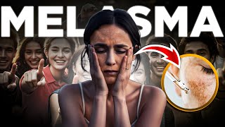 Manchas no Rosto Nunca Mais! O Que é o MELASMA e Como Tratar?