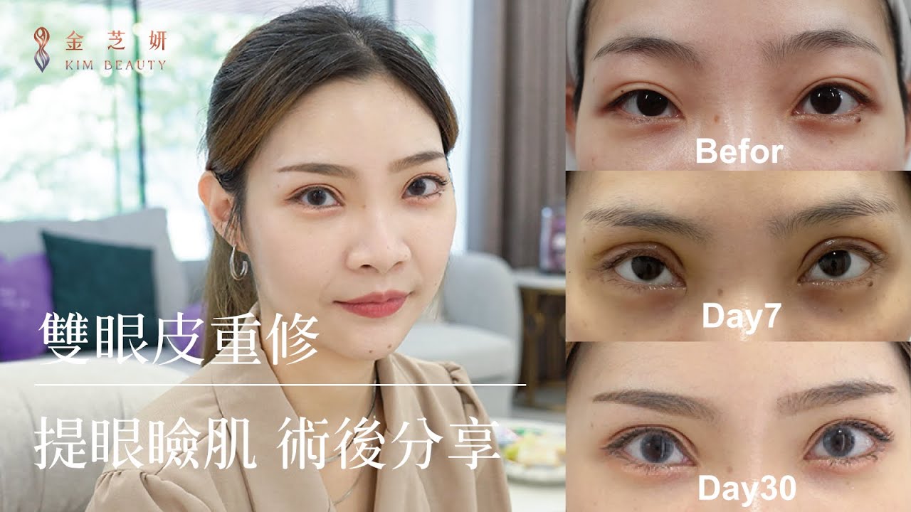 雙眼皮重修+提眼瞼肌案例分享「徹底解決大小眼困擾」 | 金芝妍醫美診所 陳承謙醫師