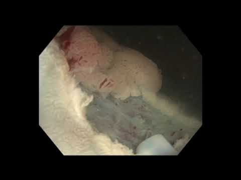 Colonoscopia - extirpación de un pólipo del recto