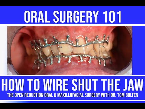 How To Wire Shut The Jaw | Step By Step Live Instruction | Closed Reduction With Arch Bars